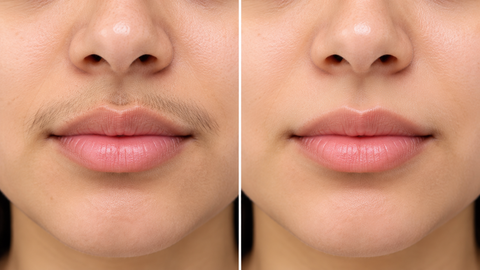 Laser Hair Removal for Upper Lip: Complete Treatment Guide